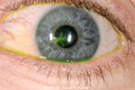 角膜溃疡-眼疾-插图-2