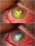 角膜溃疡-眼疾-插图-1
