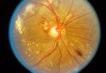 高血压性视网膜病变-眼疾-插图-