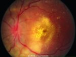 高血压性视网膜病变-眼疾-插图-2