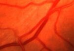 高血压性视网膜病变-眼疾-插图-1